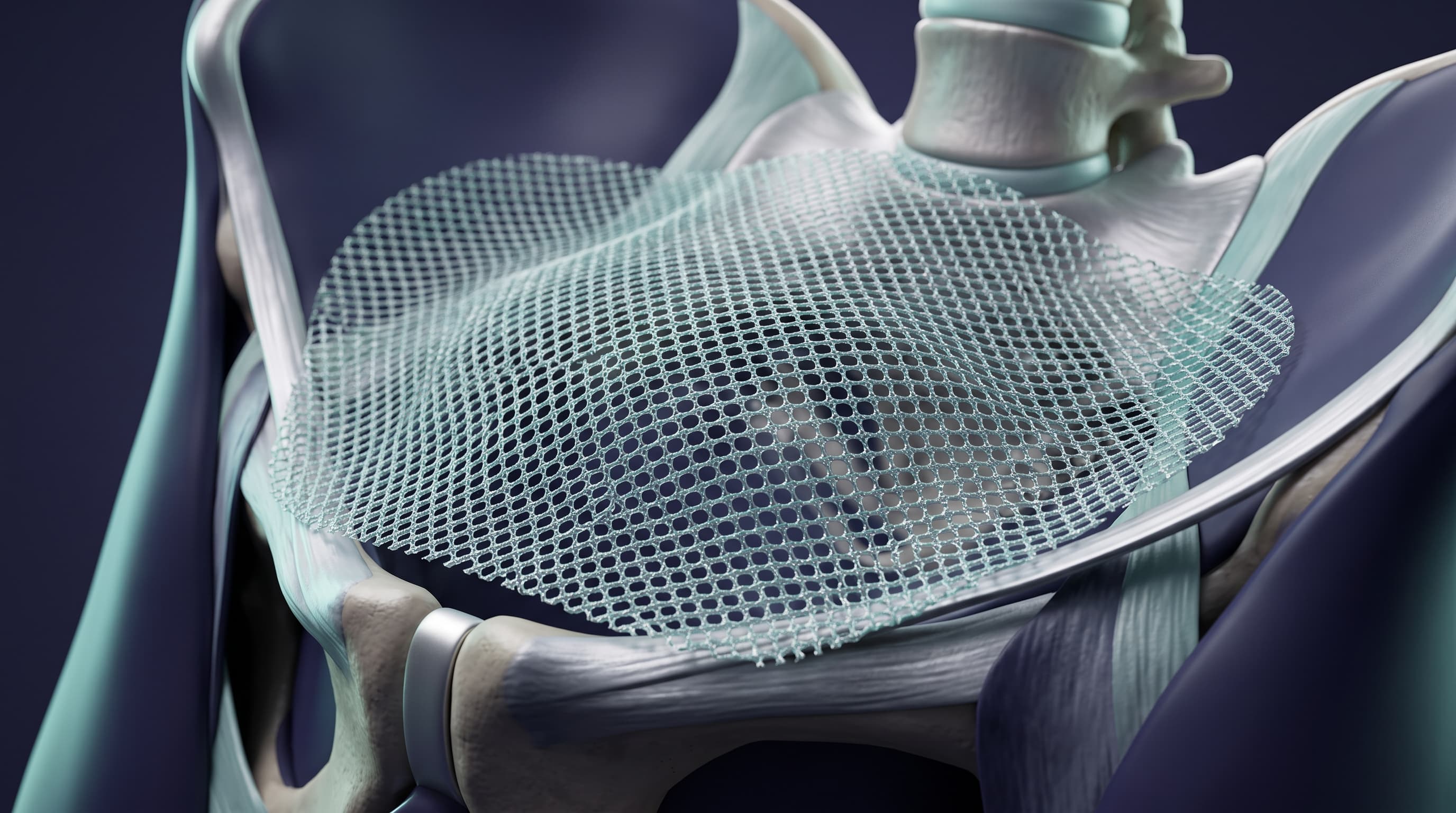Hernioplastía Inguinal con Malla Libre de Tensión